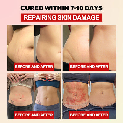 Only 5-6 pieces left, extra 30% off! 💕 Restore your perfect body and solve women's health problems. If you miss this opportunity, you'll have to wait until next year.